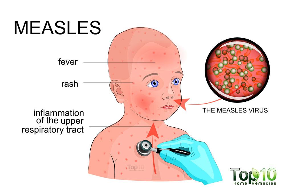Does my Child Have the Measles